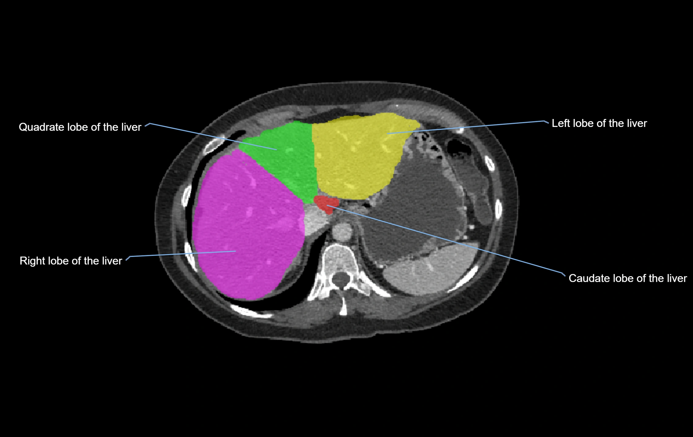 CT lliver lobes axial cross sectional anatomy labelled image -00058.webp